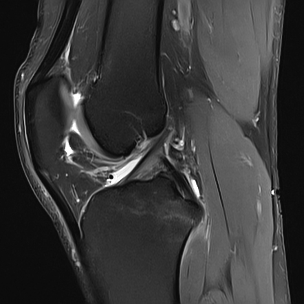 Ramp lesion of knee | Radiology Case | Radiopaedia.org