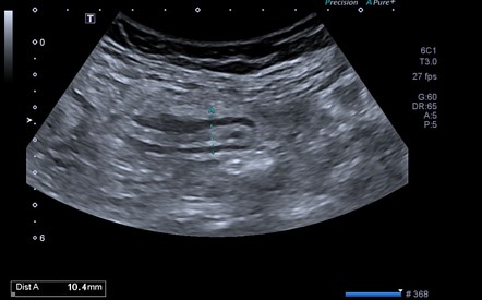 Acute appendicitis | Image | Radiopaedia.org