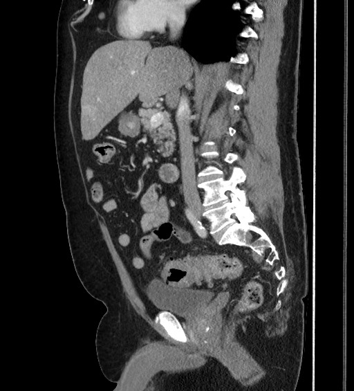 Acute Uncomplicated Sigmoid Diverticulitis Image