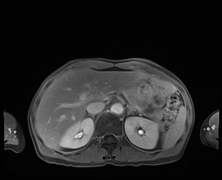 Normal adrenal glands MRI | Image | Radiopaedia.org