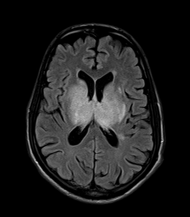 Deep cerebral vein thrombosis with venous infarction | Radiology Case ...