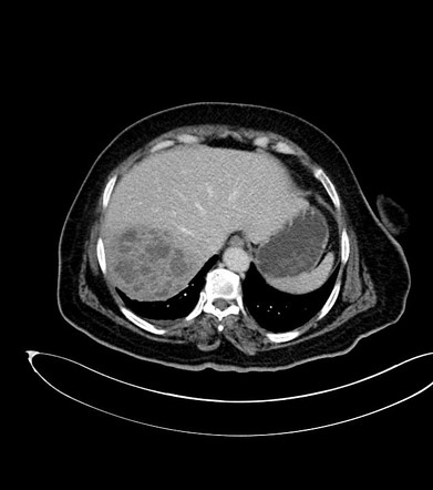 Klebsiella | Radiology Reference Article | Radiopaedia.org