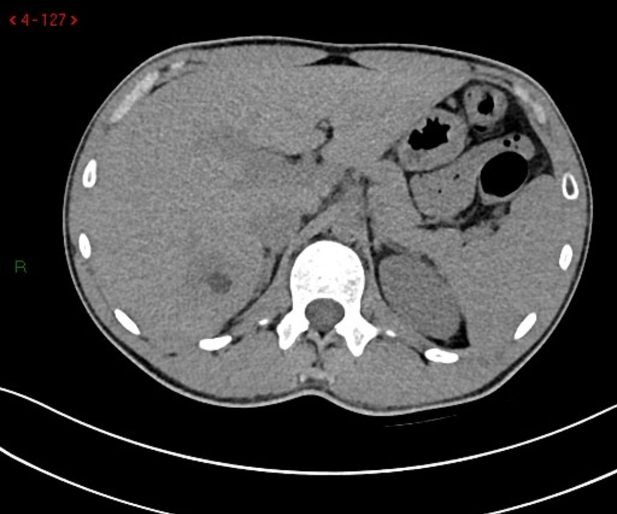 Echinococcal liver abscess | Image | Radiopaedia.org