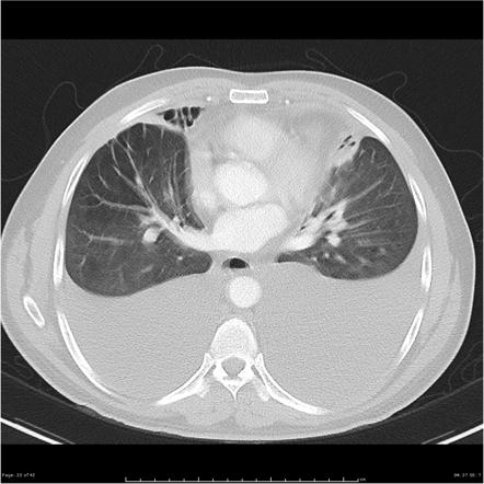 Pleural Effusion Summary Radiology Reference Article Radiopaedia Org