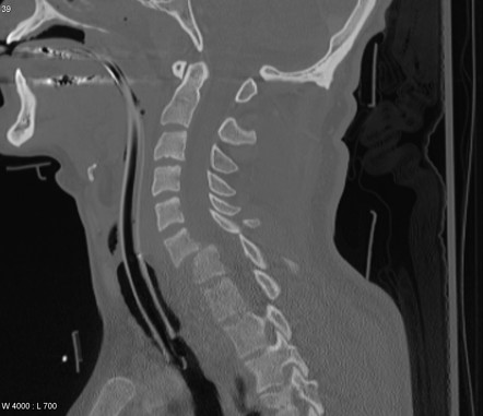 Cervical Spine Fractures | Radiology Reference Article | Radiopaedia.org