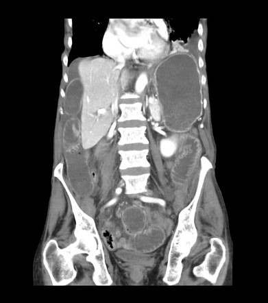 Strangulated femoral hernia with small bowel obstruction | Image ...