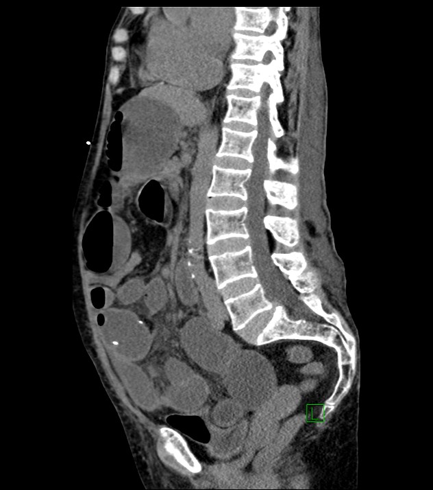 Small Bowel Ischemia With Bowel Obstruction | Image | Radiopaedia.org