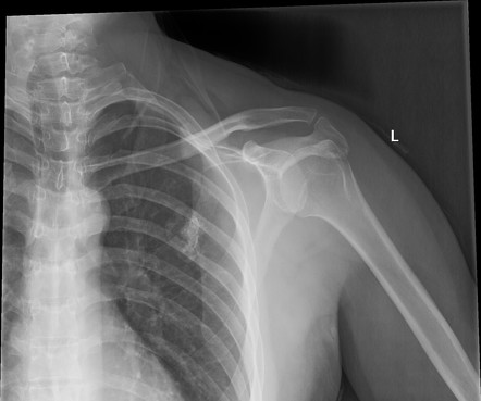 Osteochondroma | Radiology Reference Article | Radiopaedia.org