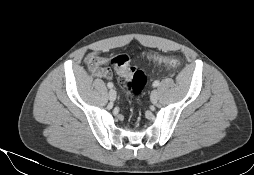 Acute diverticulitis - Hinchey stage Ia | Image | Radiopaedia.org