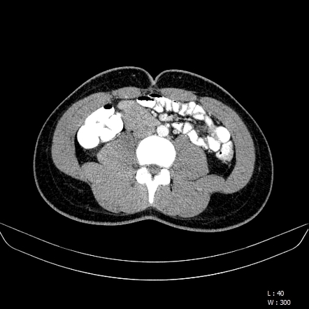 Right paraduodenal hernia | Image | Radiopaedia.org