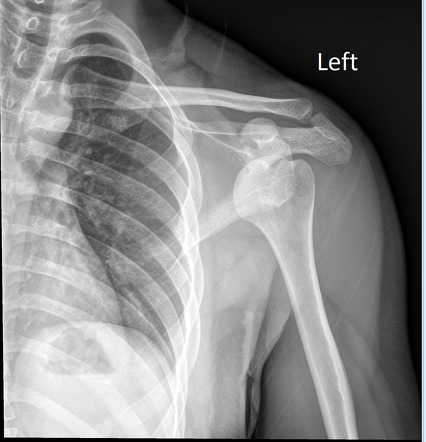 Anterior shoulder dislocation | Radiology Case | Radiopaedia.org