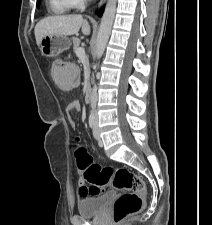 Ileocecal non-Hodgkin lymphoma (NHL) with intussusception | Image ...