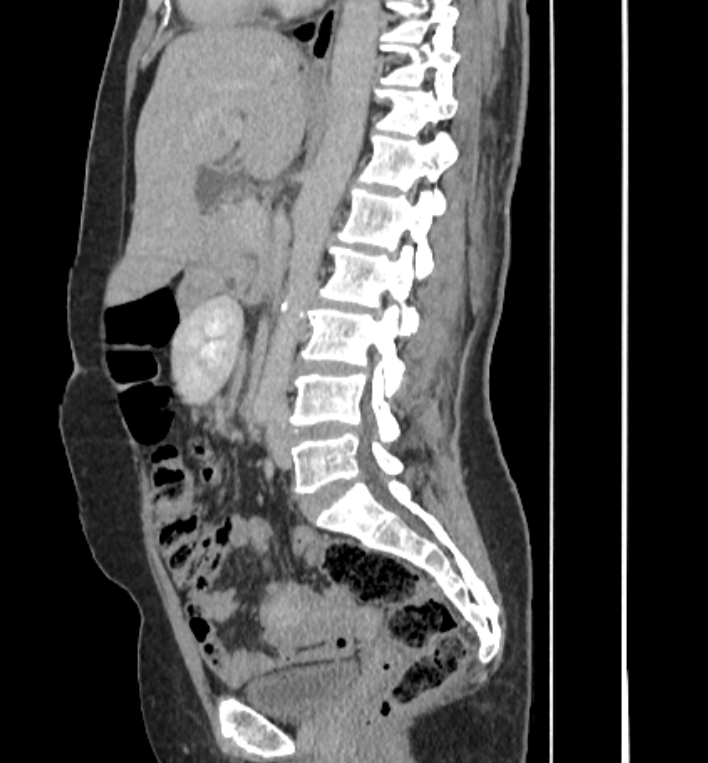 Retroperitoneal sarcoma | Image | Radiopaedia.org