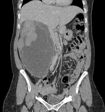 Retroperitoneal sarcoma | Radiology Case | Radiopaedia.org