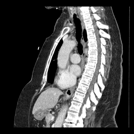 Plombage | Image | Radiopaedia.org