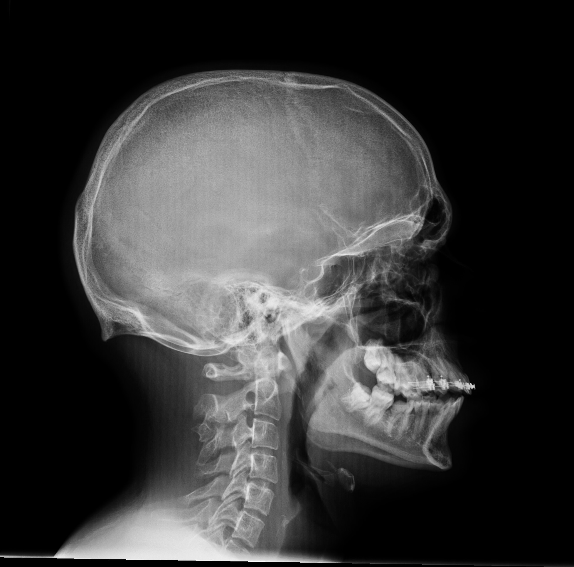 Hereditary multiple exostoses | Image | Radiopaedia.org