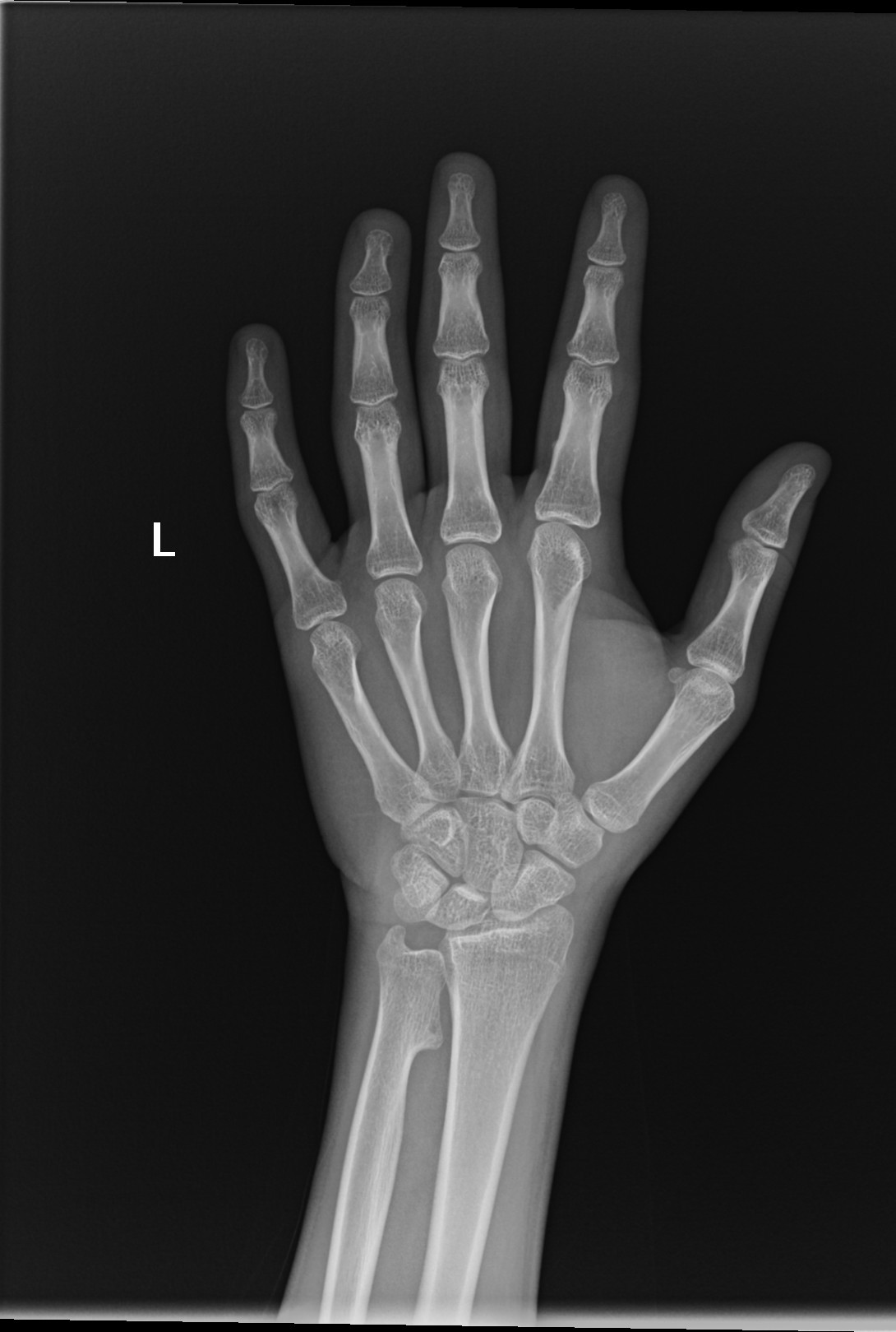 Normal Wrist X Ray