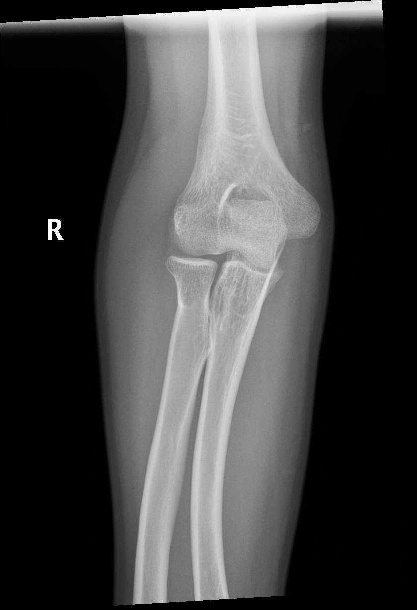 Hereditary multiple exostoses | Image | Radiopaedia.org