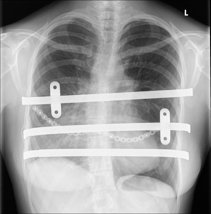 Basal pneumothorax | Radiology Case | Radiopaedia.org