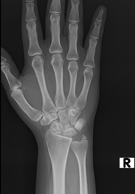 styloid process x ray