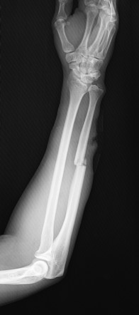 Ulna fracture | Radiology Case | Radiopaedia.org