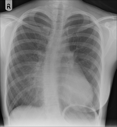 Pectus excavatum | Radiology Reference Article | Radiopaedia.org