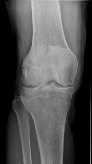 Multipartite patella | Radiology Reference Article | Radiopaedia.org