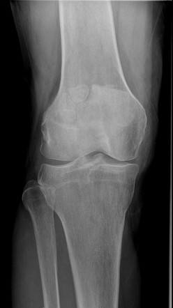 Tripartite patella | Radiology Case | Radiopaedia.org