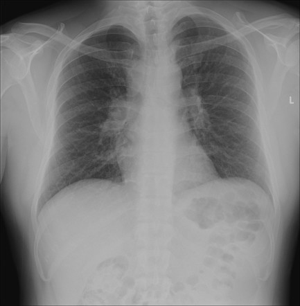 Garland triad - sarcoidosis | Radiology Case | Radiopaedia.org