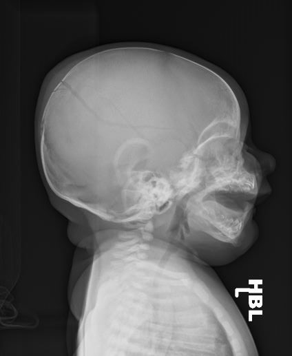 Diastatic skull fracture | Image | Radiopaedia.org