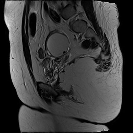 T2 Dark Spot Sign (endometrioma) | Radiology Reference Article ...