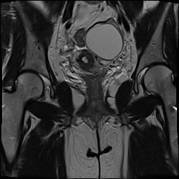 Endometrioma | Image | Radiopaedia.org