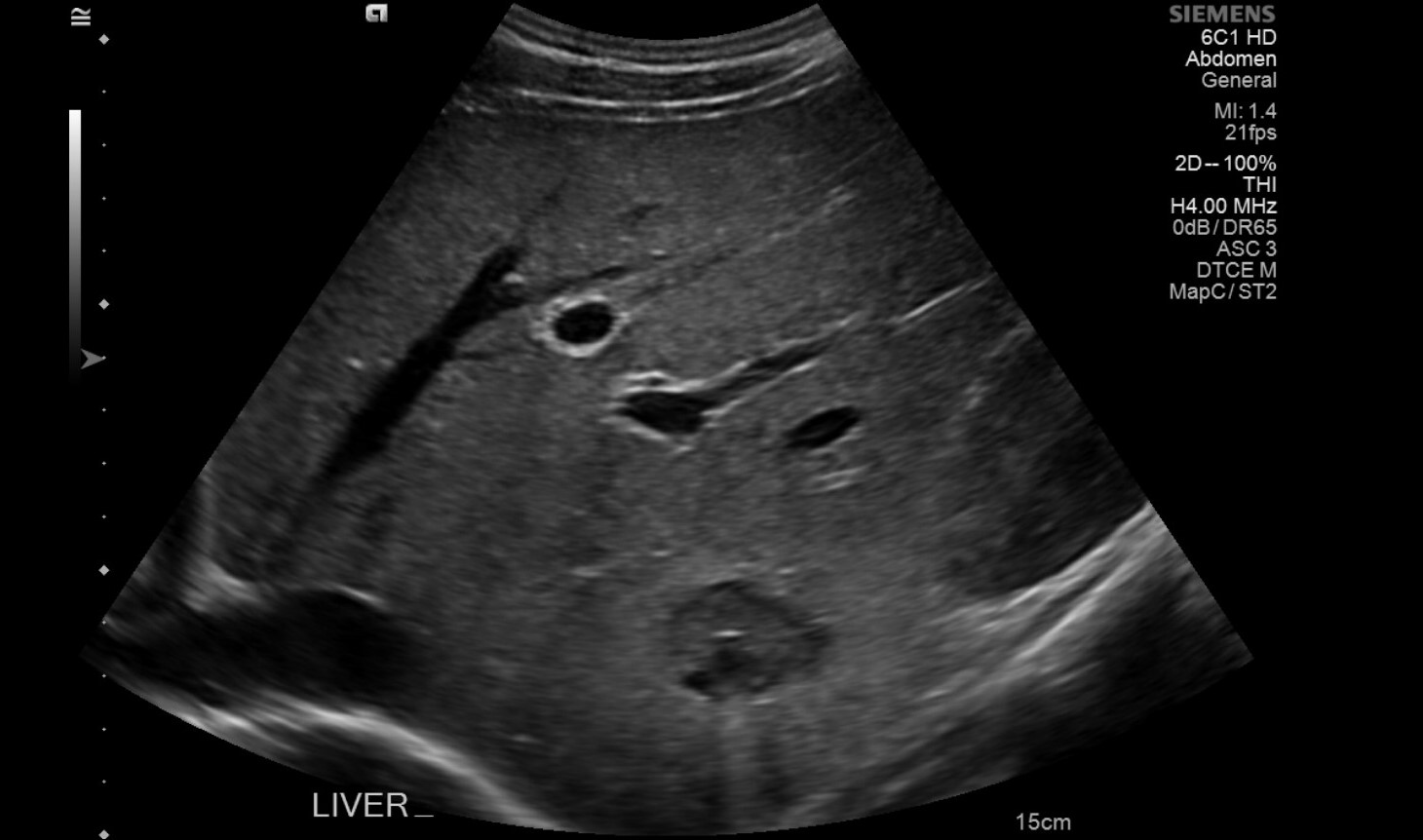 Echinococcal liver abscess | Image | Radiopaedia.org