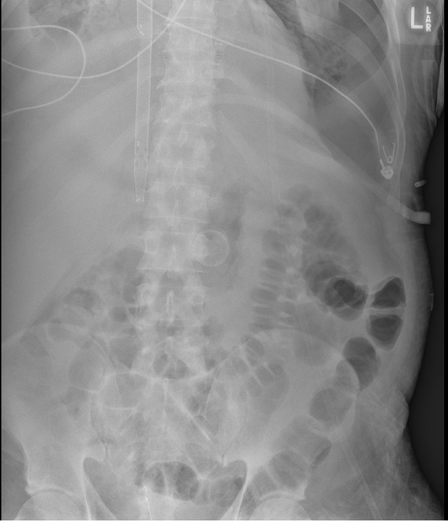 30+ Nonobstructive Bowel Gas Pattern LoveSohael