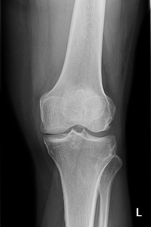 Osteochondromatosis | Radiology Case | Radiopaedia.org