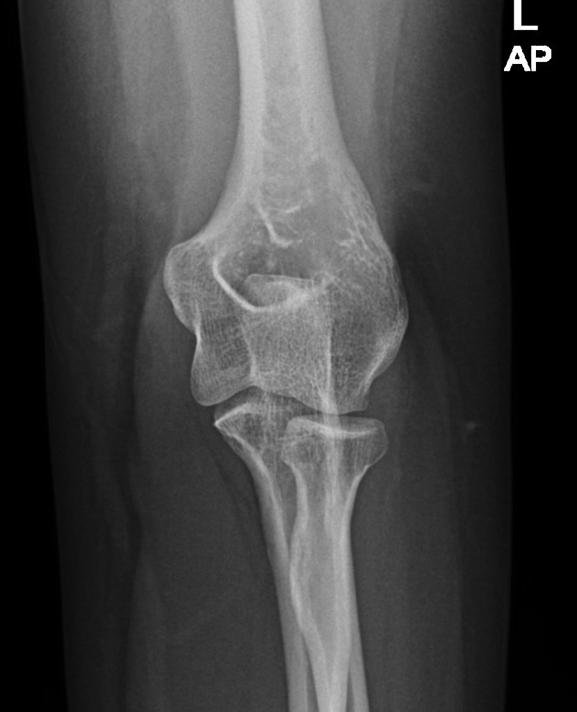 Coronoid Process Fracture Radiology Case Radiopaedia Org