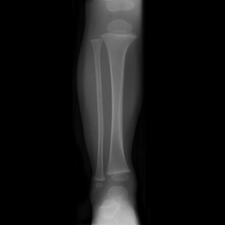 Toddler fracture | Radiology Case | Radiopaedia.org