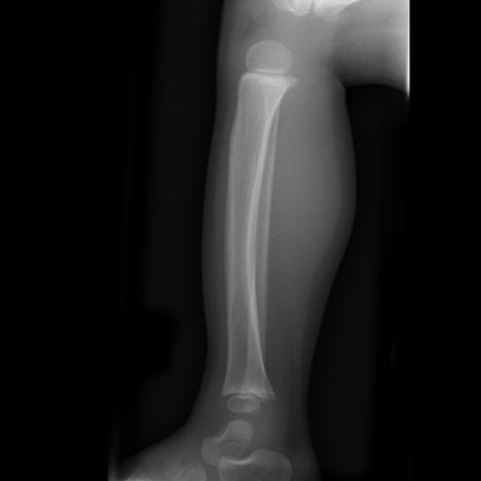 Toddler fracture | Radiology Reference Article | Radiopaedia.org