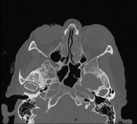 Bilateral frontal mucoceles | Image | Radiopaedia.org