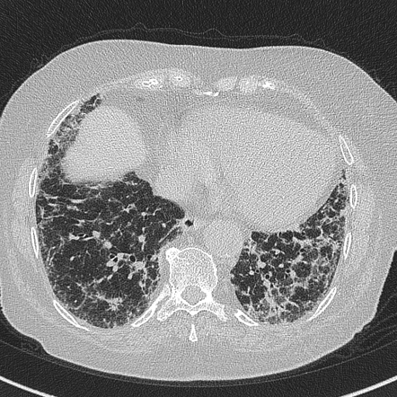 Amiodarone lung | Radiology Reference Article | Radiopaedia.org