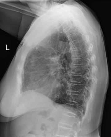 Amiodarone-induced pulmonary fibrosis | Image | Radiopaedia.org