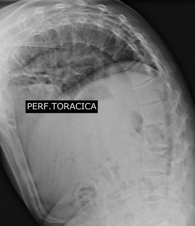 Thoracic hyperkyphosis | Radiology Case | Radiopaedia.org