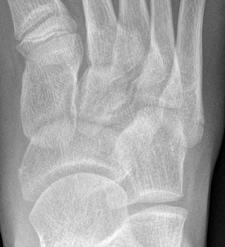 Bipartite 5th metatarsal apophysis | Image | Radiopaedia.org