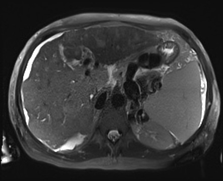 Metastatic hepatocellular carcinoma with tumor thrombus | Image ...