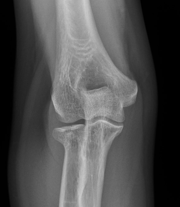 Elbow Joint Effusion - Fat Pad Sign 