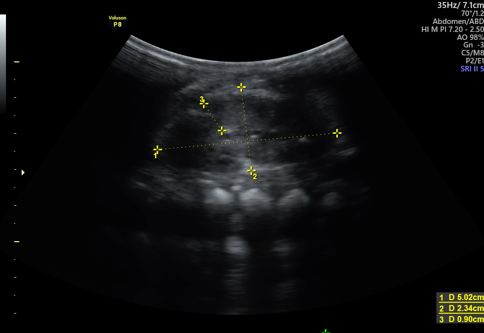 outcome-of-isolated-fetal-renal-pyelectasis-diagnosed-during