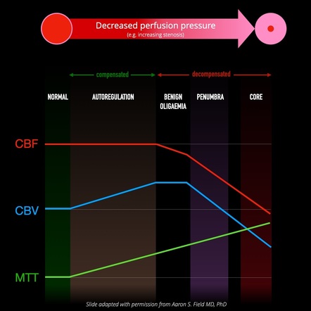 CT perfusion in ischemic stroke | Radiology Reference Article ...