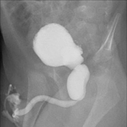 Bladder Outlet Obstruction Radiology Reference Article Radiopaedia Org