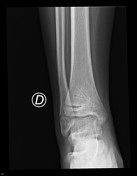 Physeal arrest | Radiology Reference Article | Radiopaedia.org