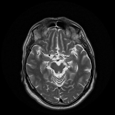 Wallerian degeneration post striatocapsular infarct | Radiology Case ...